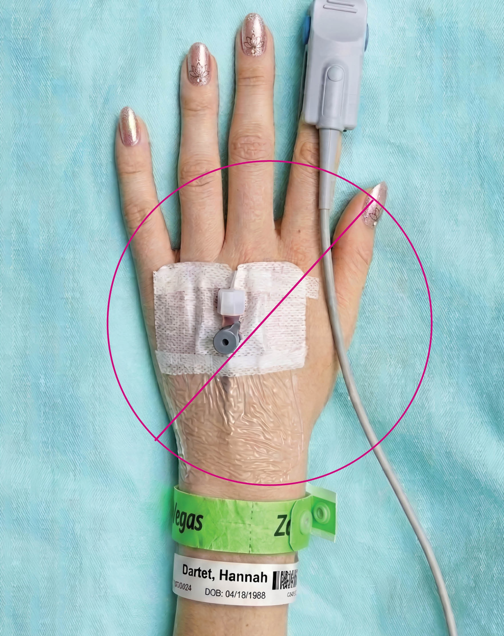 Hand with IV wristband